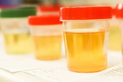 bright yellow urine pregnancy sign